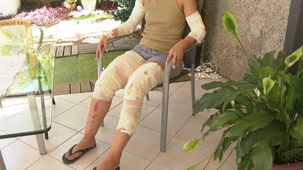 Mulher sentada em uma cadeira na varanda, com extensos curativos e faixas cobrindo as duas pernas e os braços, além de hematomas visíveis na canela, recuperando-se dos graves ferimentos causados pela tentativa de feminicídio Serra ES.